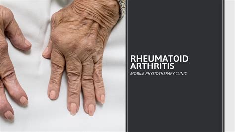 Rheumatoid Arthritis Cause Symptoms Diagnosis Treatment Exercise