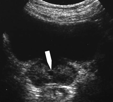 Midline Prostatic Cysts In Healthy Men Incidence And Transabdominal Sonographic Findings Ajr