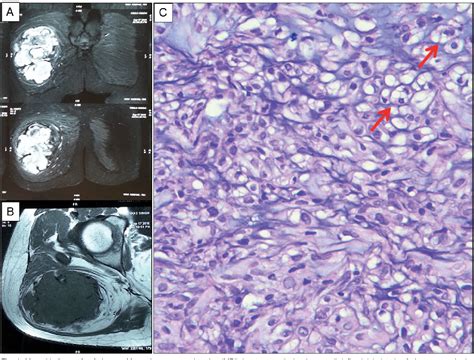 Figure 1 From Myoepithelial Tumor Of Soft Tissue And Bone A Current