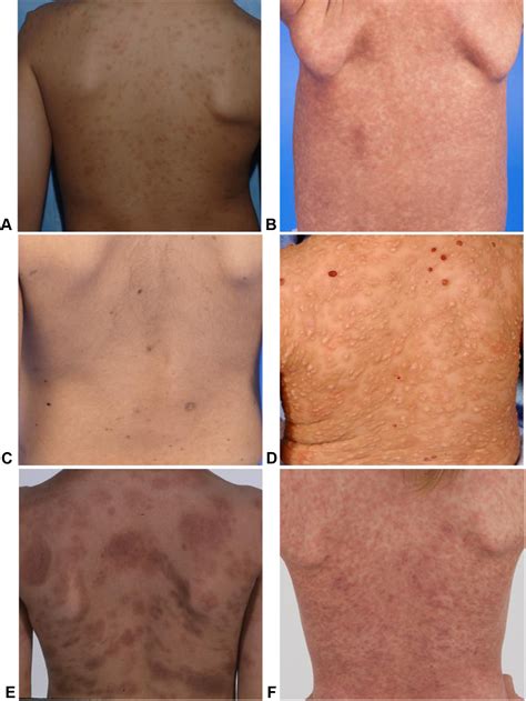 Maculopapular Cutaneous Mastocytosis In A Diverse Population The