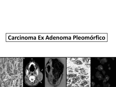Carcinoma Ex Adenoma Pleomorfico