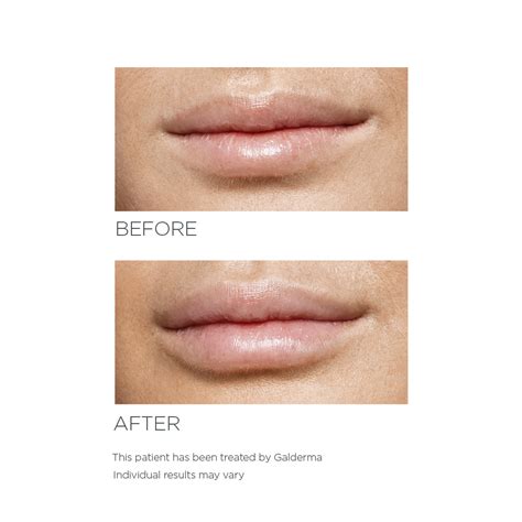 Lip Fillers Sydney Lip Enhancement The Skin Project