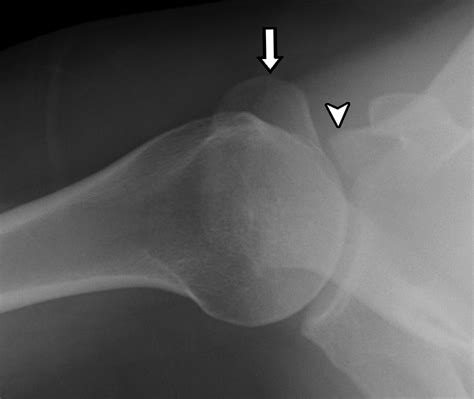 Imaging Of The Acromioclavicular Joint Anatomy Function Pathologic