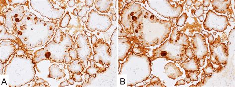 Mesothelin Expression In Ovary Serous Carcinoma A And B Both 5b2 A