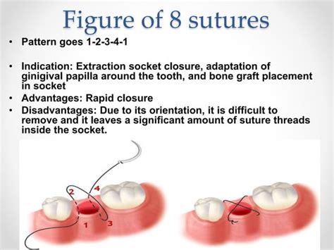 Suturing Techniques Involved In Dental Surgery