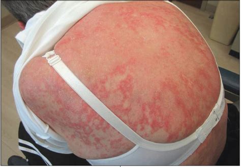 Subacute Cutaneous Lupus Erythematosus Consultant360