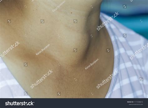 Zooming Closeup Lateral View Enlarged Thyroid Stock Photo 1117208015
