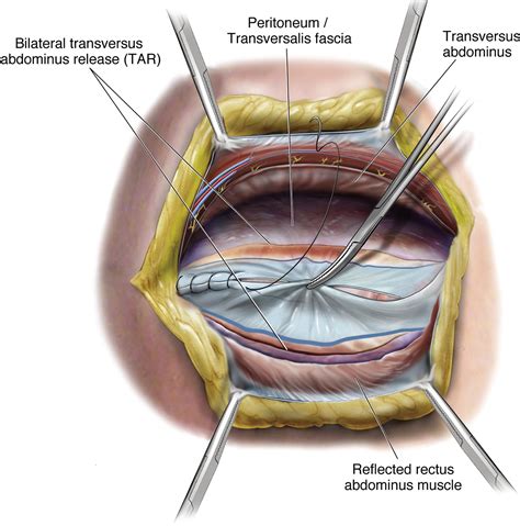 Open Ventral Hernia Repair With Component Separation Surgical Clinics