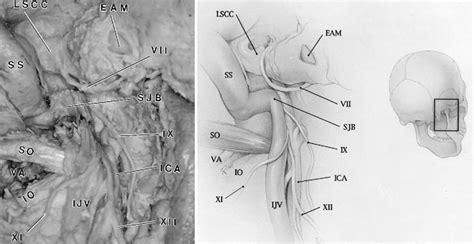 Jugular Foramen Syndrome