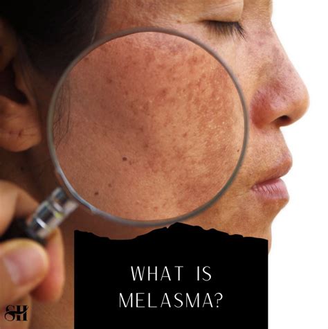 What Is Melasma And How To Treat It Skin Harmonics