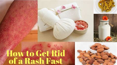 How To Get Rid Of A Rash Fast And Naturally At Home Rashes Faster
