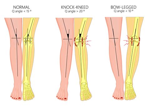Varus Knee Bow Legged Correction In Babe Adults Part Bangkok Advanced Clinics