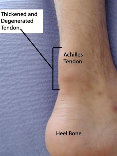 Sprains Strains And Other Soft Tissue Injuries