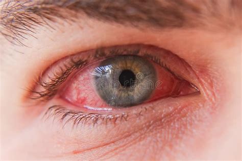Conjunctivitis Macro The Inflamed Eye Stock Photo Image Of