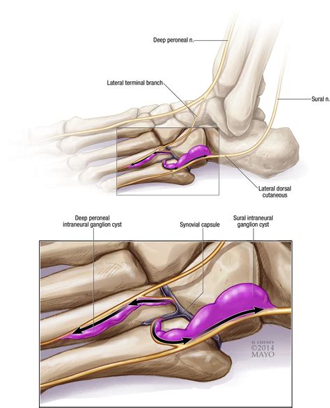 Concurrent Lateral Dorsal Cutaneous And Deep Peroneal Intraneural Ganglion Cysts In The Foot