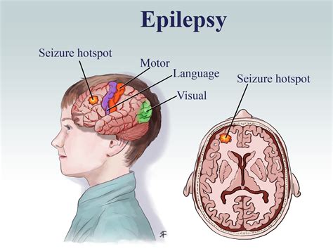 Epilepsy What Are Seizures And Epilepsy Epilep