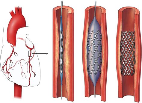 What Happens During The Procedure Of Coronary Angioplasty Docopd
