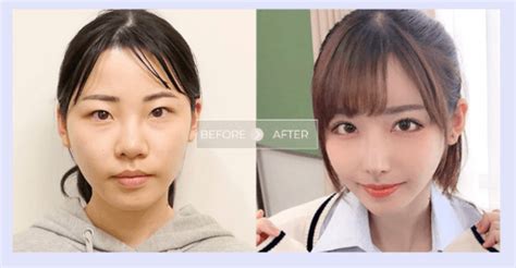 eimi fukada surgery photo【id cosmetic surgery】 surprise impact before after from a sober and