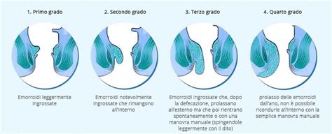 Emorroidi