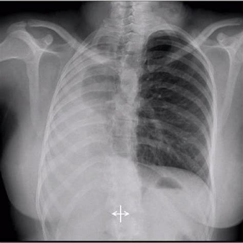 X Ray Chest Pa View A Homogeneous Opacity In The Right Upper Middle