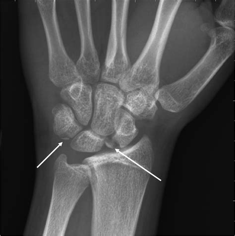 Avulsion Fractures Of The Scaphoid And Triquetrum In A 15 Year Old