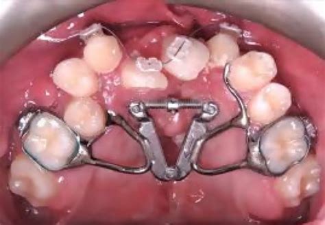 Palate Expander What It Is And How It Works Best Orthodontist Nyc