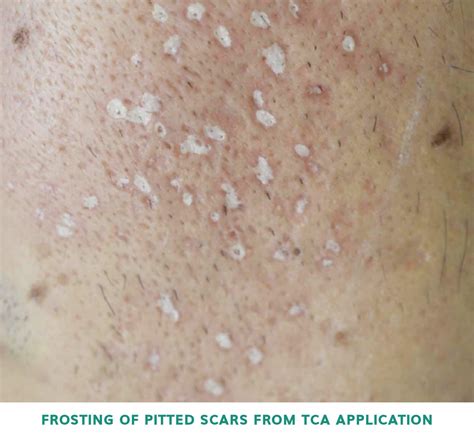 Tca Cross Singapore Effective Acne Scar Treatment