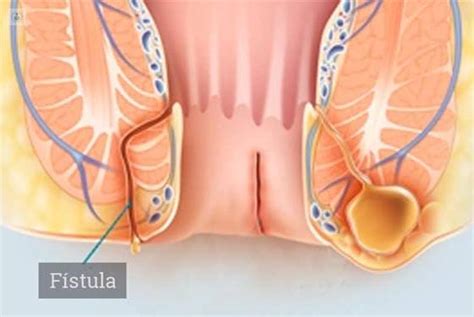 Cirugía de la Fístula Anal qué es síntomas y tratamiento Top Doctors