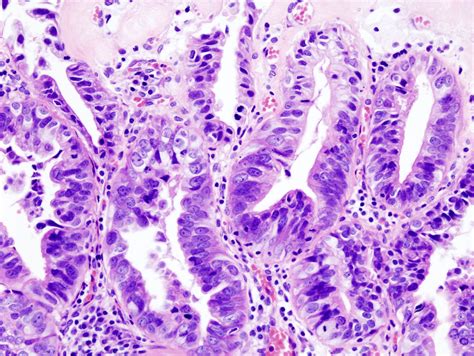 Filegallbladder Adenocarcinoma 2 Histopathology Wikipedia