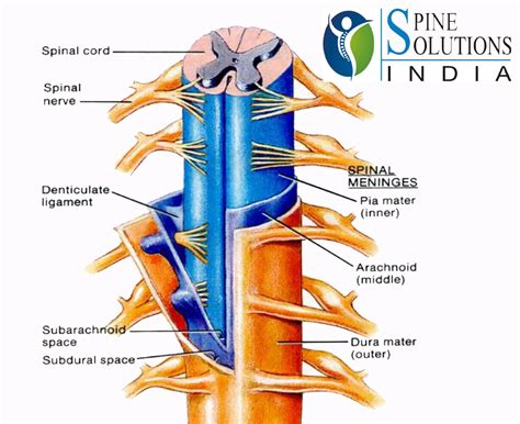 Spine Solutions India By Dr Sudeep Jain Arachnoiditis A Chronic Pain