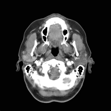 Adenoid Cystic Carcinoma Of The Parotid Radiology Case