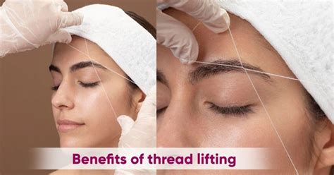 Benefits Of Thread Lifting Treatment Facethetics Beauty