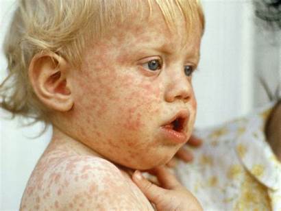 Measles Children Babycenter Babies