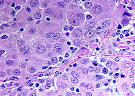 Patients with epithelioid cancer cells respond best to treatment. Epithelioid Mesothelioma | Treatment, Prognosis & Diagnosis