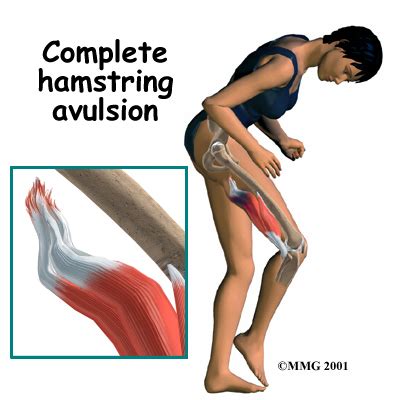 Patellar tendonitis involves small tears in the tendon that connects the kneecap to the shin. A Pulled Muscle