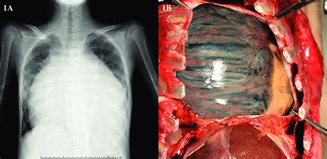 Heart On Chest X Ray Anatomy