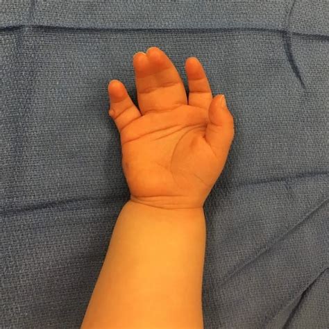 Congenital Hand And Arm Differences Washington University In St Louis