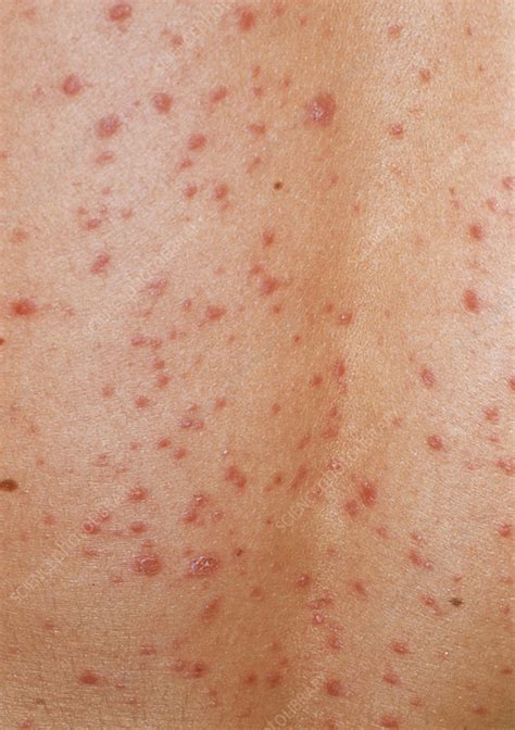 Guttate Psoriasis Skin Rash Stock Image M2400356 Science Photo