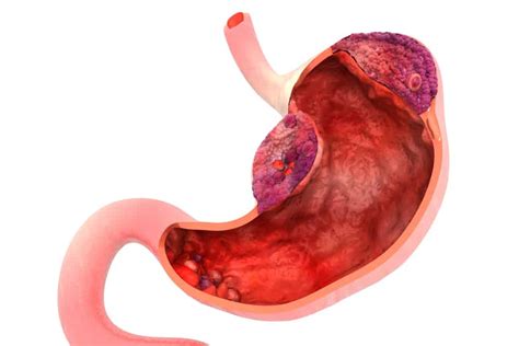 Stomach Cancer Stage 3 Survival Rate Prognosis And Treatment