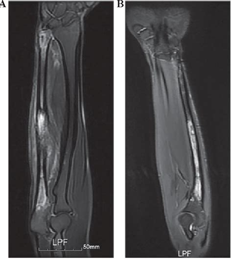Figure 1 From Ewings Sarcoma Of The Ulna Treated With Sub Total