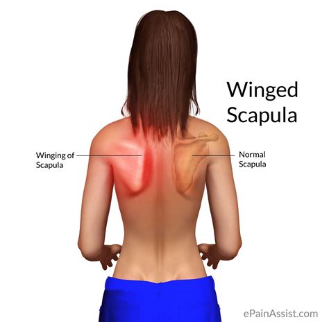 Winged Scapula Or Scapular Winging Treatment Exercise Causes