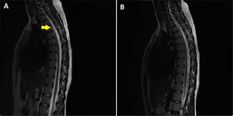 Case 1 A Preoperative Mri Of The Thoracic Spine Showing Dorsal Csf