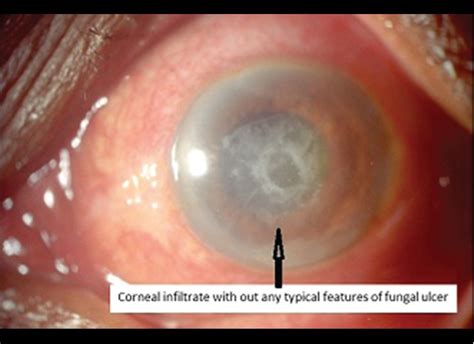 Cunninghamella Spinosum Fungal Corneal Ulcer First Case Report