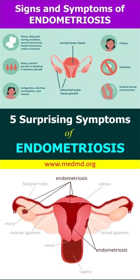 Surprising Symptoms Of Endometriosis Endometriosis Symptoms Endometriosis Health Facts