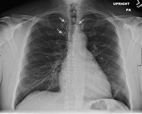 Chest Radiograph Posterior Anterior View Demonstrating Sternal Wire