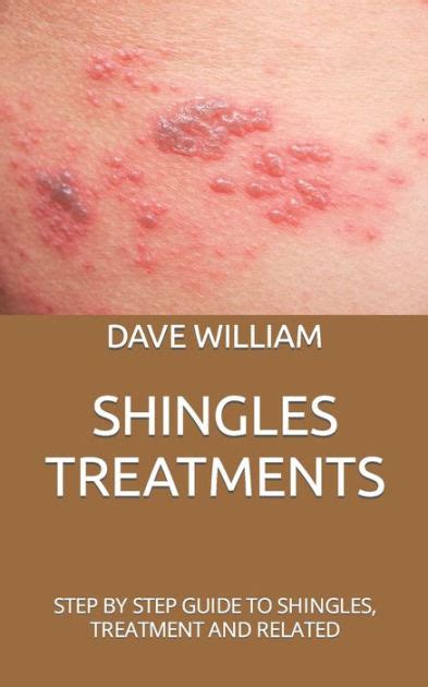 Shingles Treatments Step By Step Guide To Shingles Treatment And