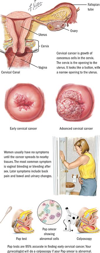 Before actual cancer cells in the cervix develop, the tissues of the cervix. Cervical Cancer | Spectrum Health