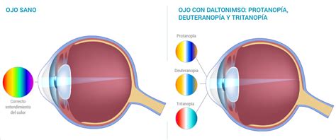 Daltonimso Tipos Causas Y Síntomas Optogestion