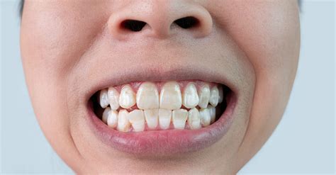 Brown Spots On Teeth Causes Prevention And Treatment