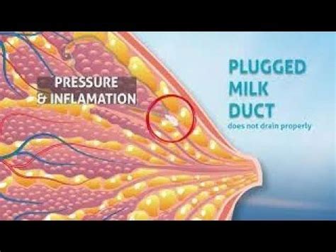 Breast Pain Caused By A Clogged Milk Duct